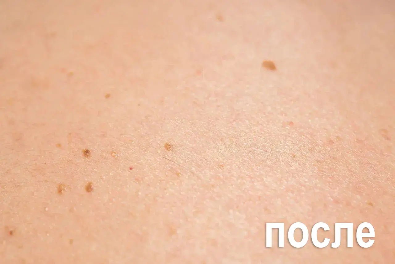 Результат Клареол — кожа после удаления папилломы, официальный сайт